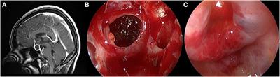 Endoscopic Endonasal Resection of Symptomatic Rathke Cleft Cysts: Total Resection or Partial Resection